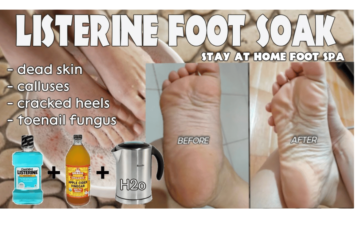 Apple Cider Vinegar on Feet 