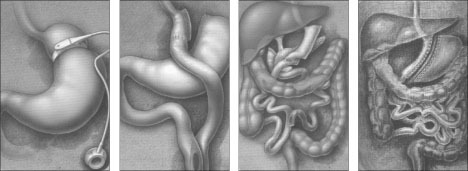 Types of weight loss surgeries offered at St. Francis Hospital include (from left to right): Adjustable Gastric Band (also known as Lap Band)