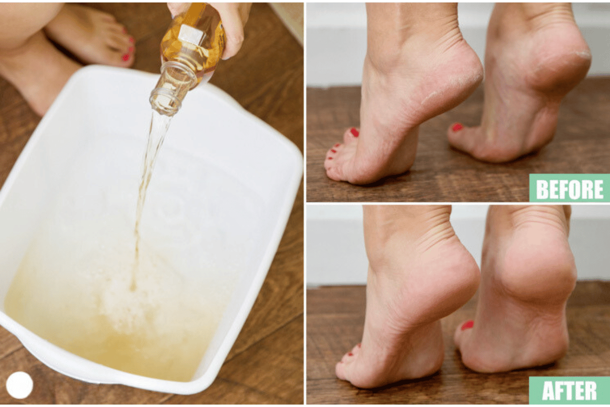 soaking feet in apple cider vinegar