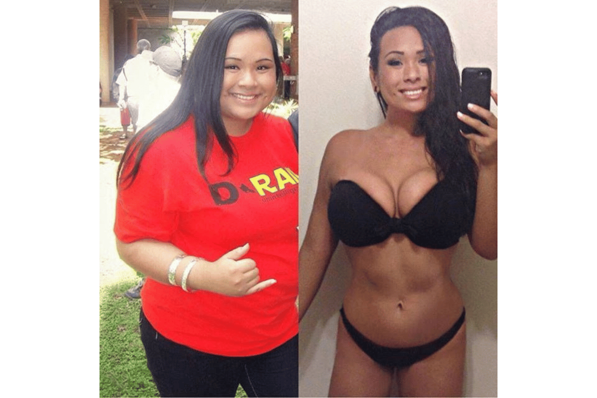 weight loss surgery